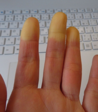 Raynaud sindromas ir miegas — kodėl naktimis šąla rankos ir kojos ir kaip su tuo kovoti