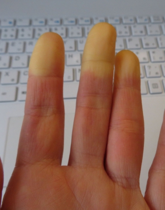 Raynaud sindromas ir miegas ir kodėl naktimis šąla rankos ir kojos ir kaip su tuo kovoti