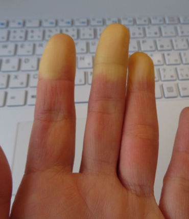Raynaud sindromas ir miegas — kodėl naktimis šąla rankos ir kojos ir kaip su tuo kovoti